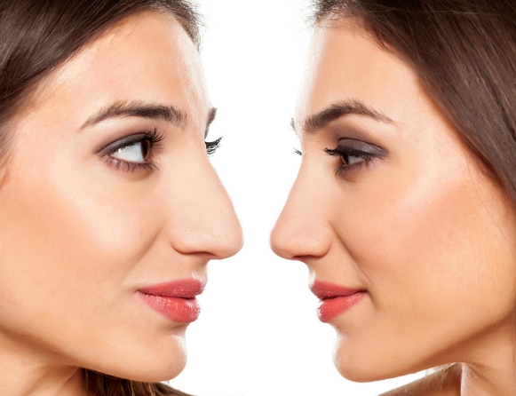 RINO ANTES Y DESPUES