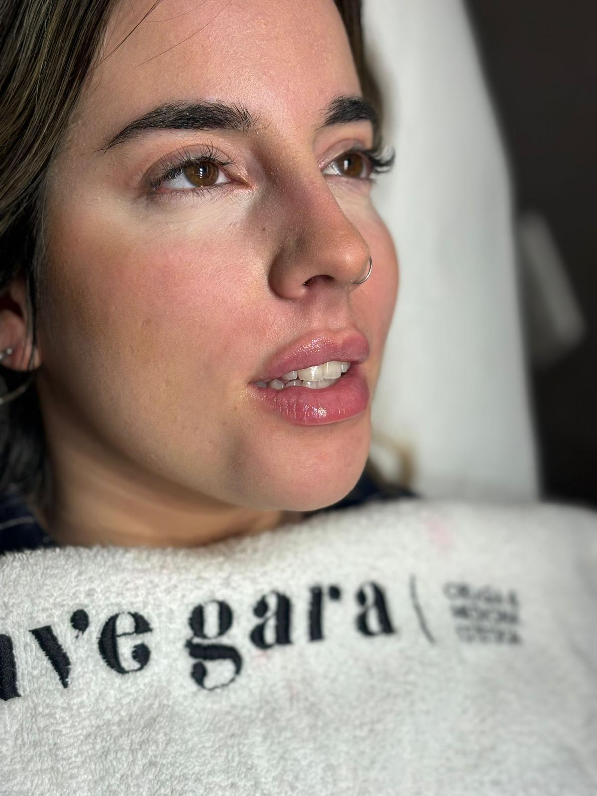 HIDRATACION LABIAL (ácido hialurónico) 2 Procedimiento de aumento de labios en Uvegara