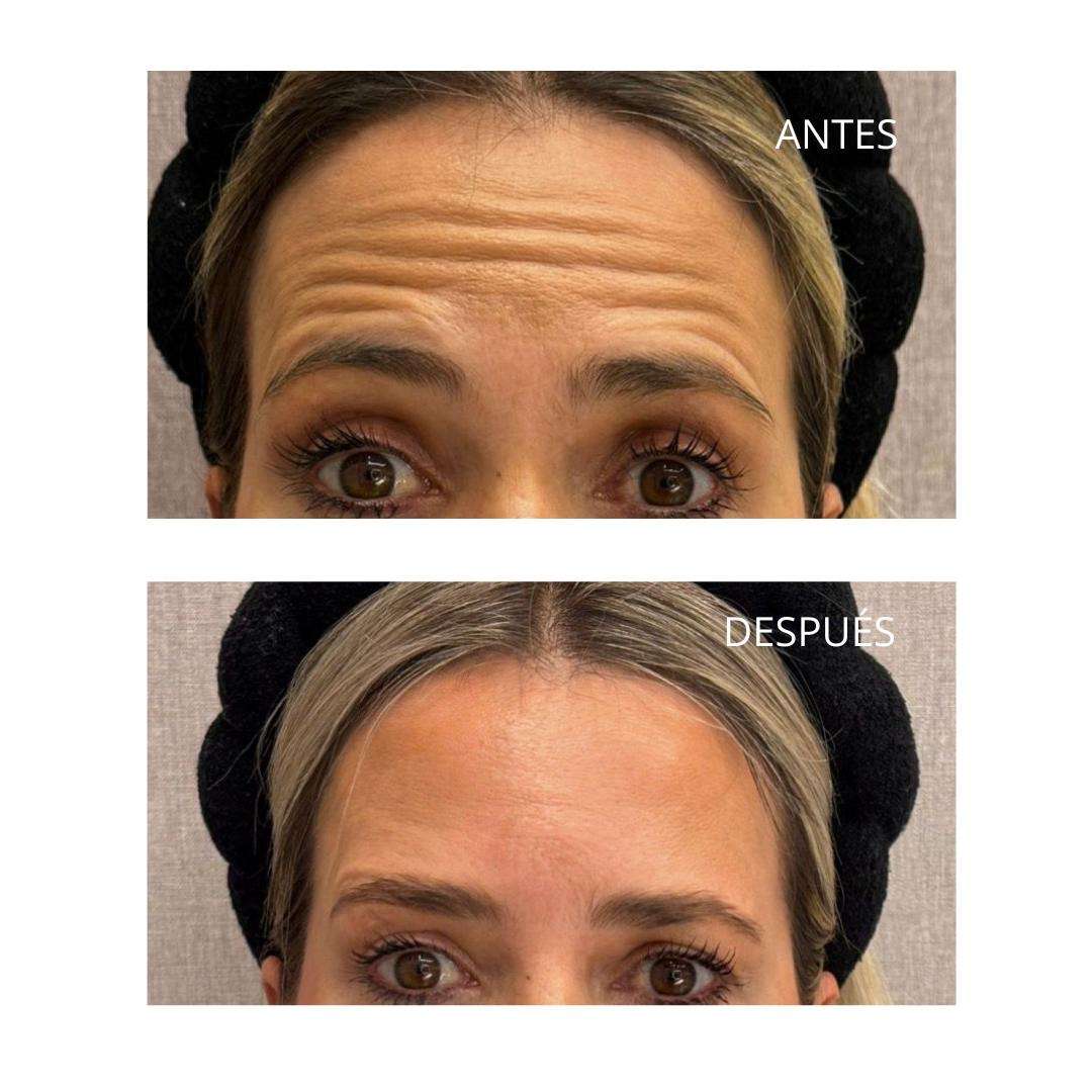 Tratamiento con neuromoduladores: la clave para un rostro joven y radiante 2 6f178aa0 895b 44d8 8259 99b07244de0f