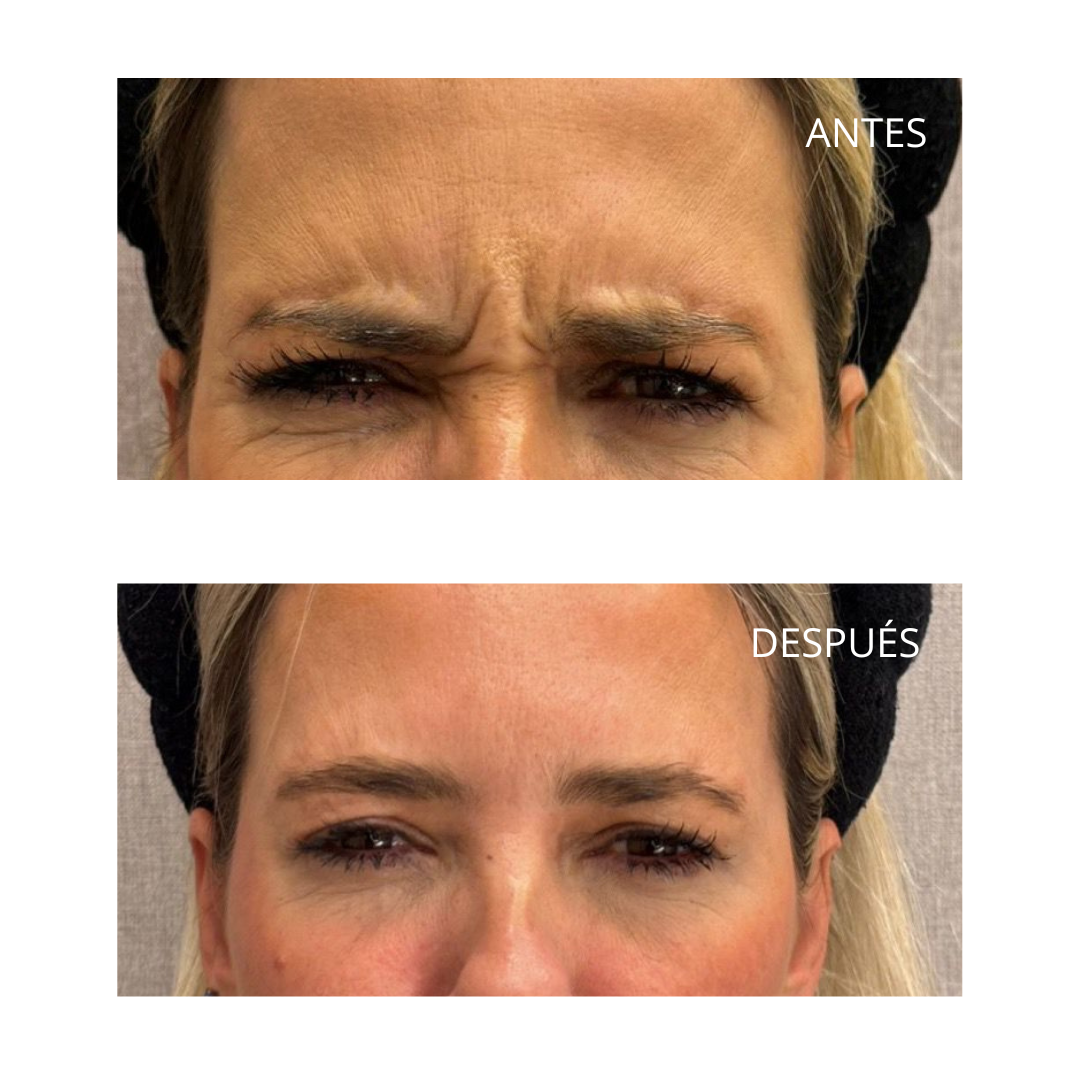 Tratamiento con neuromoduladores: la clave para un rostro joven y radiante 4 Entrecejo