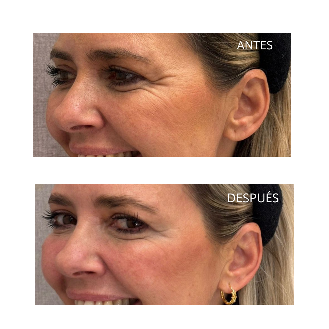 Tratamiento con neuromoduladores: la clave para un rostro joven y radiante 6 Patas de gallo