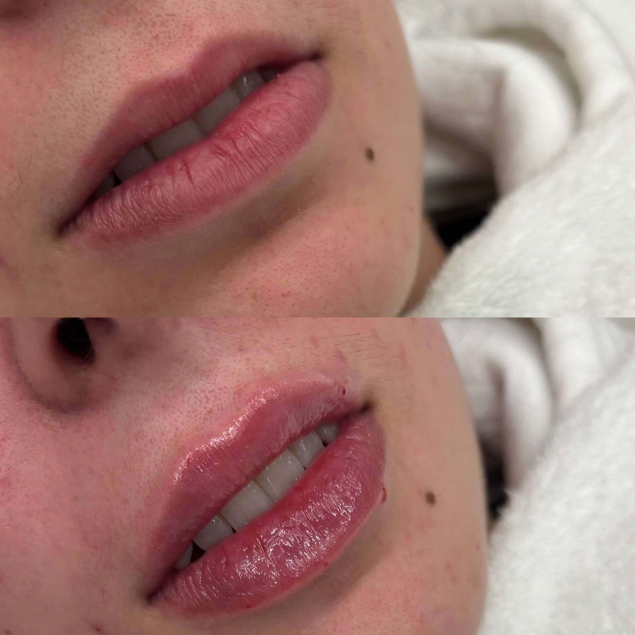 HIDRATACION LABIAL (ácido hialurónico) 1 HIDRATACION LABIAL (ácido hialurónico)