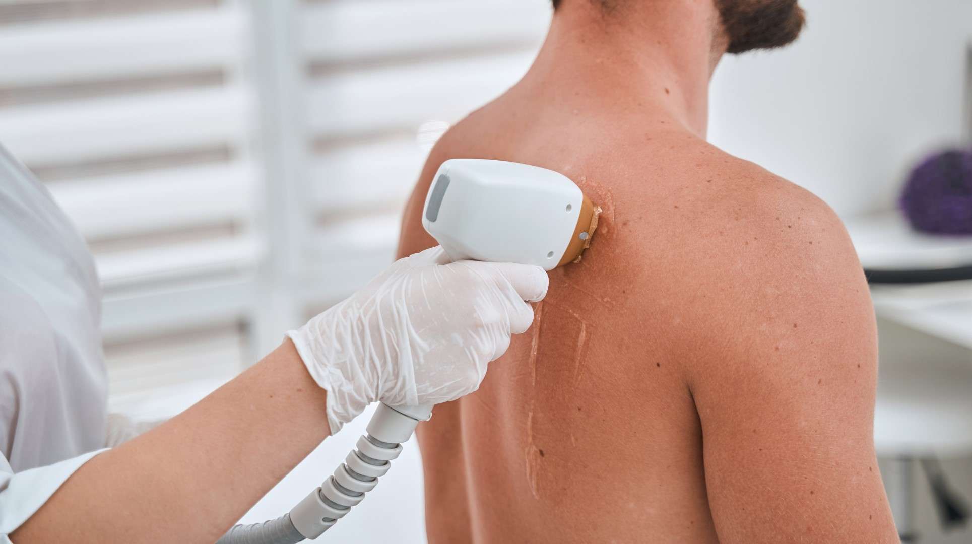 Depilación láser: la solución ideal para este momento 1 depilacion laser