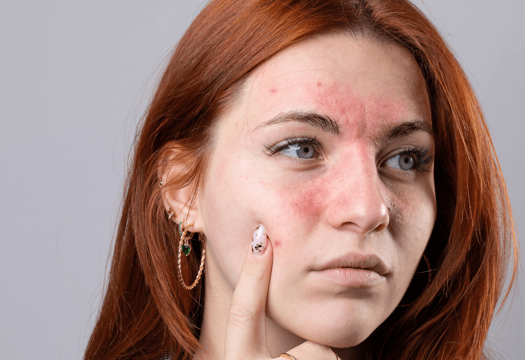 Rosácea y Cuperosis: Cómo el Láser Génesis Puede Cambiar Tu Piel 1 4 min e1744303734649