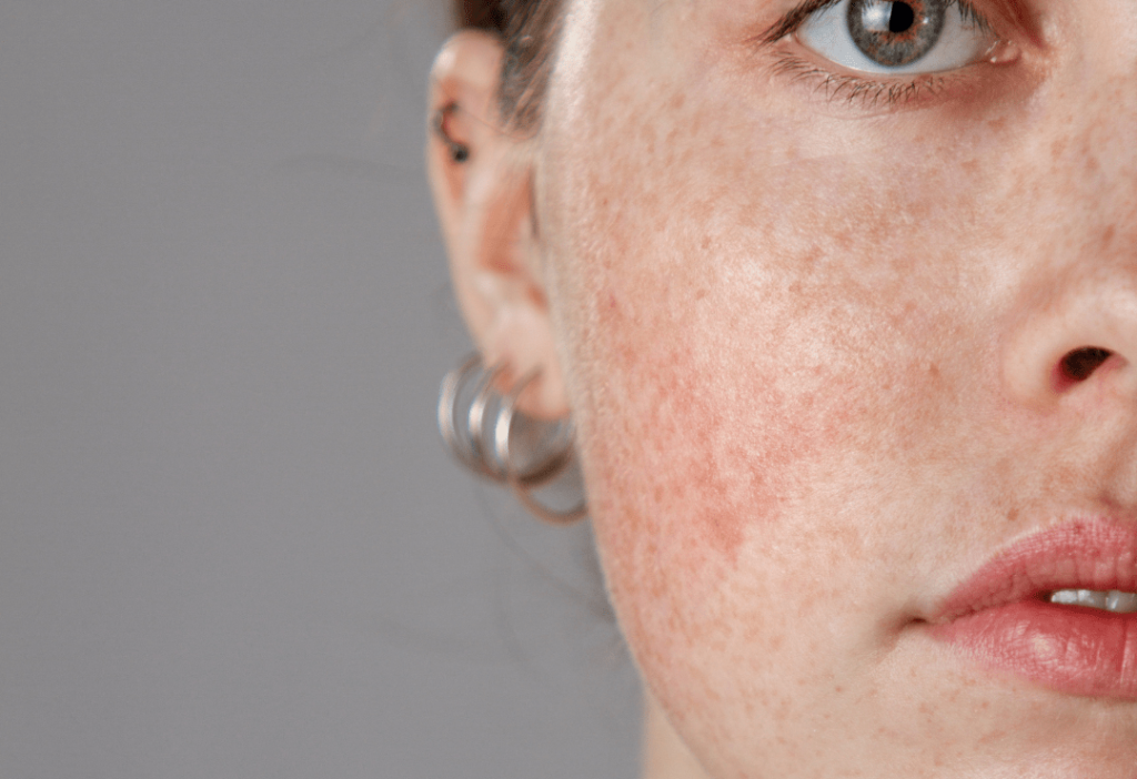 Rosácea y Cuperosis: Cómo el Láser Génesis Puede Cambiar Tu Piel 2 Rosaceas e1744303666435
