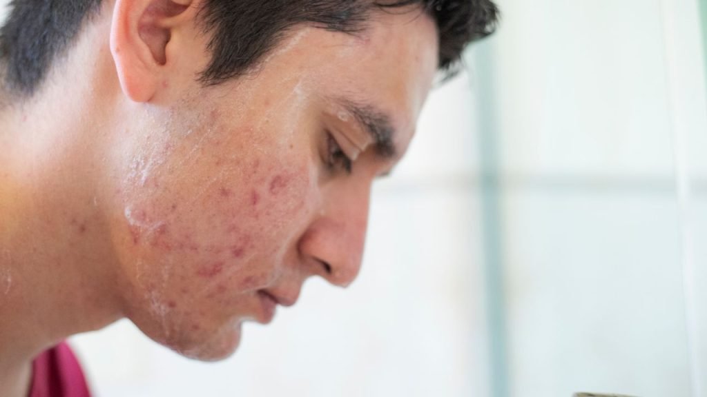Tratamientos para el acné y sus marcas en Granada: ciencia, seguridad y resultados visibles 2 Banco de imagenes 14