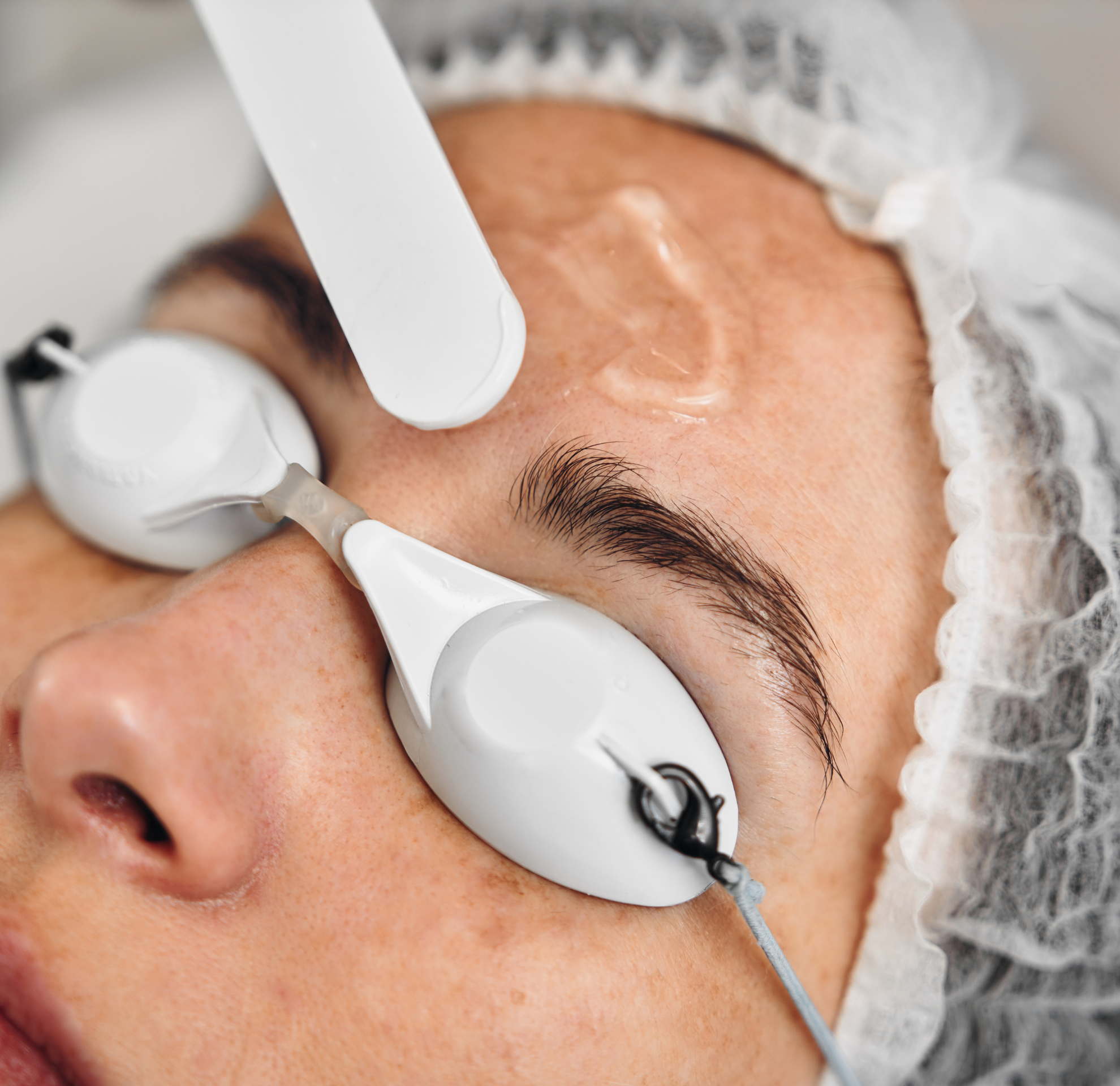 Tratamiento del melasma en Granada: ciencia, seguridad y resultados garantizados 1 Diseno sin titulo 20