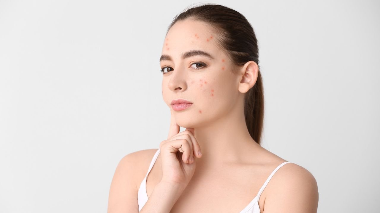 Tratamientos para el acné y sus marcas en Granada: ciencia, seguridad y resultados visibles 1 tratamientos acne