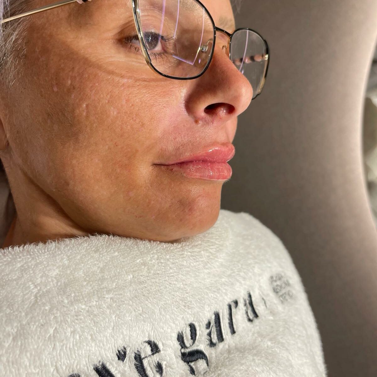 Primer plano del resultado del aumento de labios en Uvegara