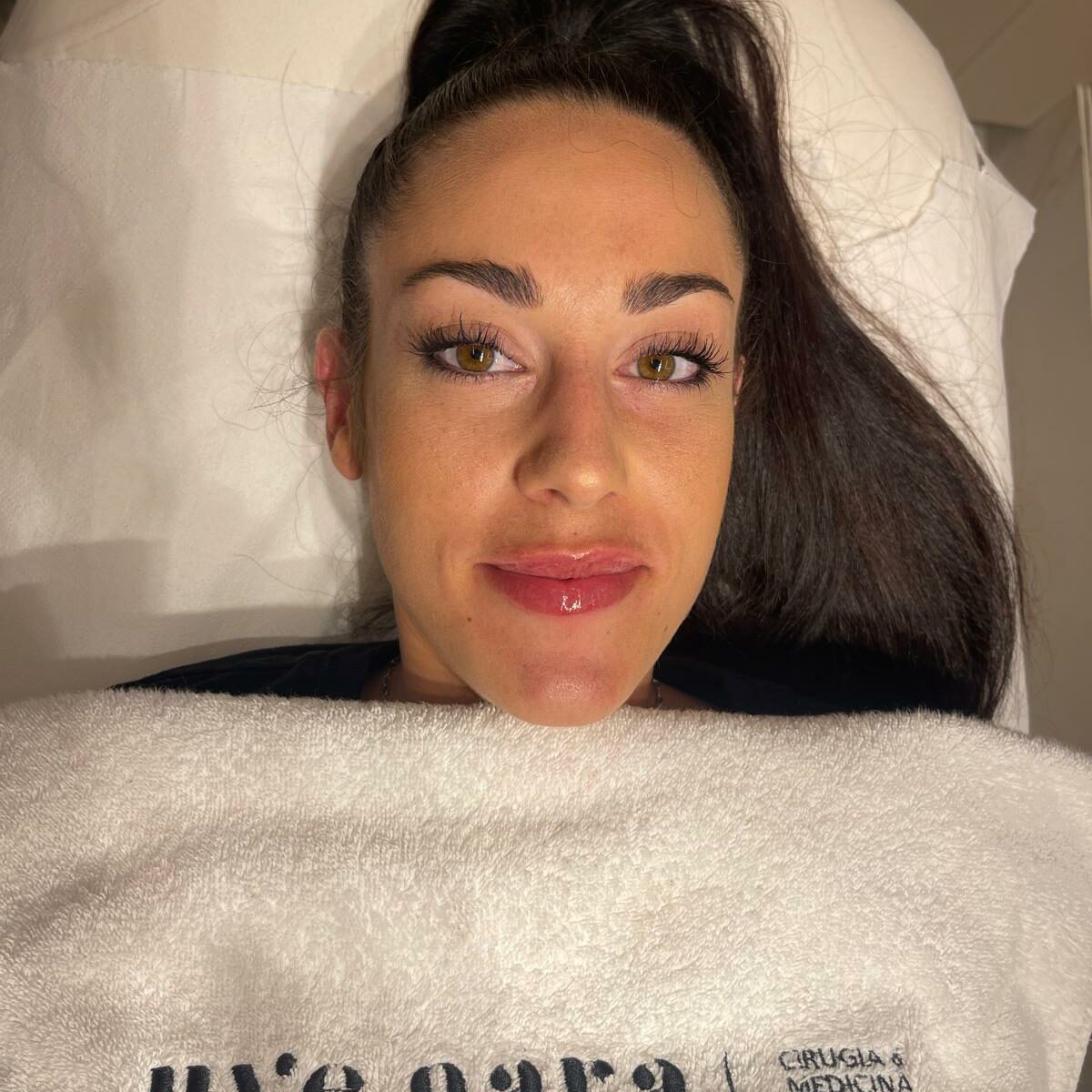 Resultado final del aumento de labios en Uvegara